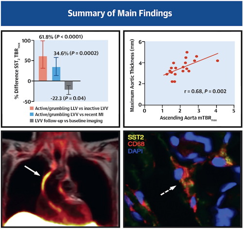 There was a strong correlation between SST2 mean TBRmax and para-aortic thickening in LVV patients